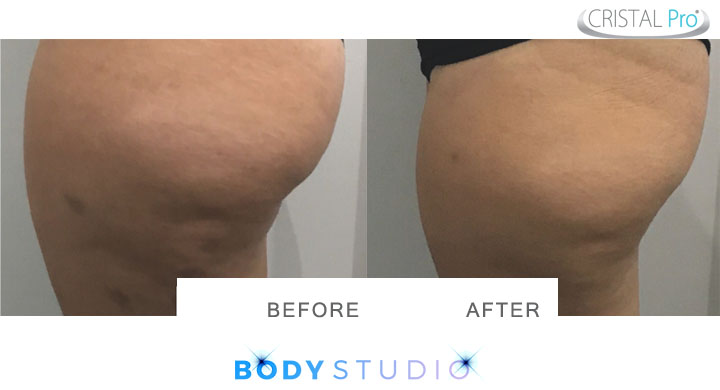 Cristal Pro Applicators at Lisa Aesthetic Center Calicut